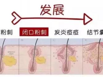 闭口：粉刺的一种类型及其形成原因和处理方法