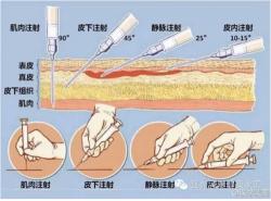 医嘱单上的皮下和皮内注射缩写：理解与运用